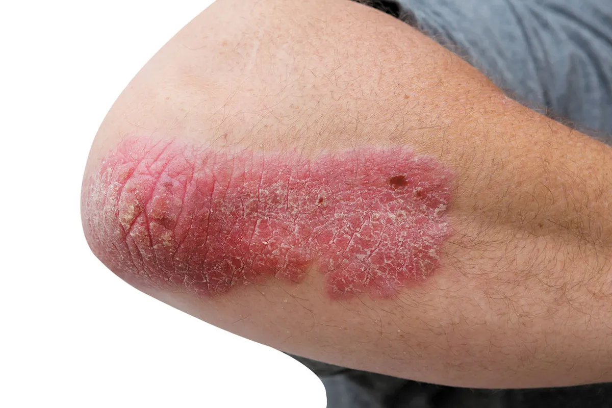 psoriasis-pieljpg